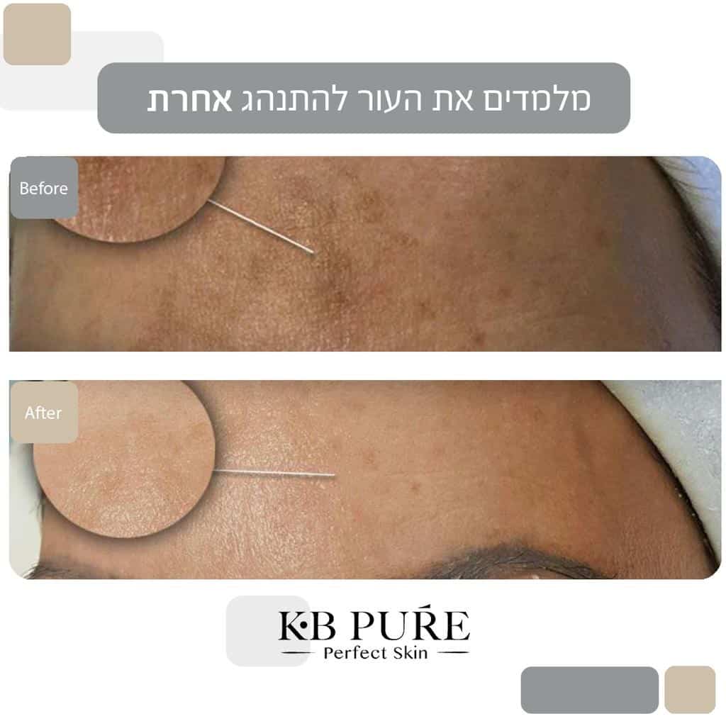 הבהרה לפני ואחרי 1